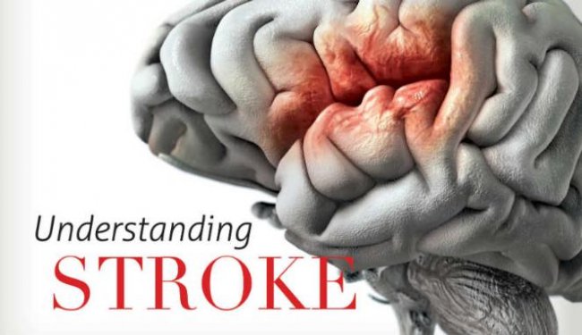 Jangan Menunggu untuk Obati Stroke, Bisa Kehilangan Bagian Otak