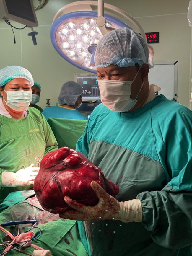 Dokter Spesialis Kandungan RSUD Jayapura Berhasil Mengoperasi Pasien Tumor Mioma Uteri Seberat 5,67 Kg 