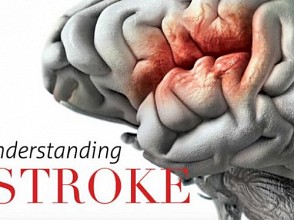 Jangan Menunggu untuk Obati Stroke, Bisa Kehilangan Bagian Otak
