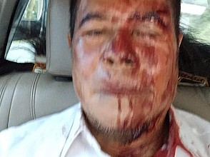 Terkena Lemparan Batu, Wajah Pj Gubernur Papua Berlumuran Darah 