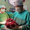 Dokter Spesialis Kandungan RSUD Jayapura Berhasil Mengoperasi Pasien Tumor Mioma Uteri Seberat 5,67 Kg 